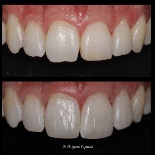 Cosmetic-Dentistry-Before-and-After-Pictures-11.jpg